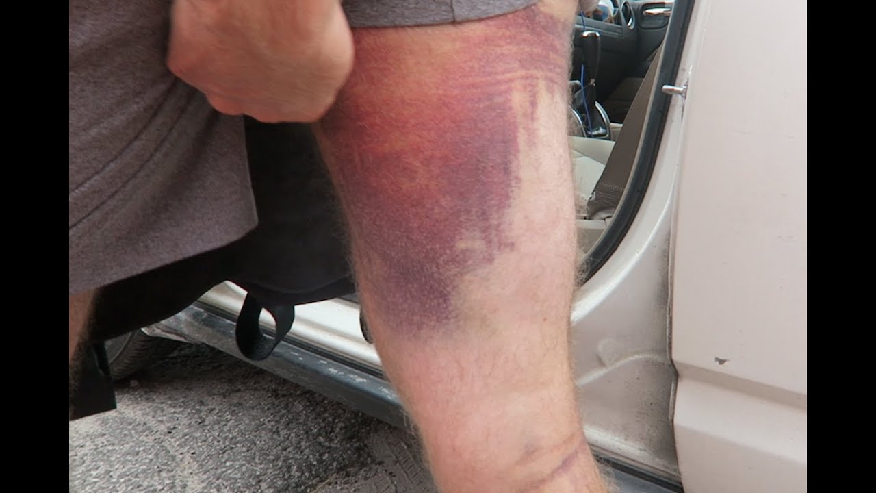 Hamstring Tear