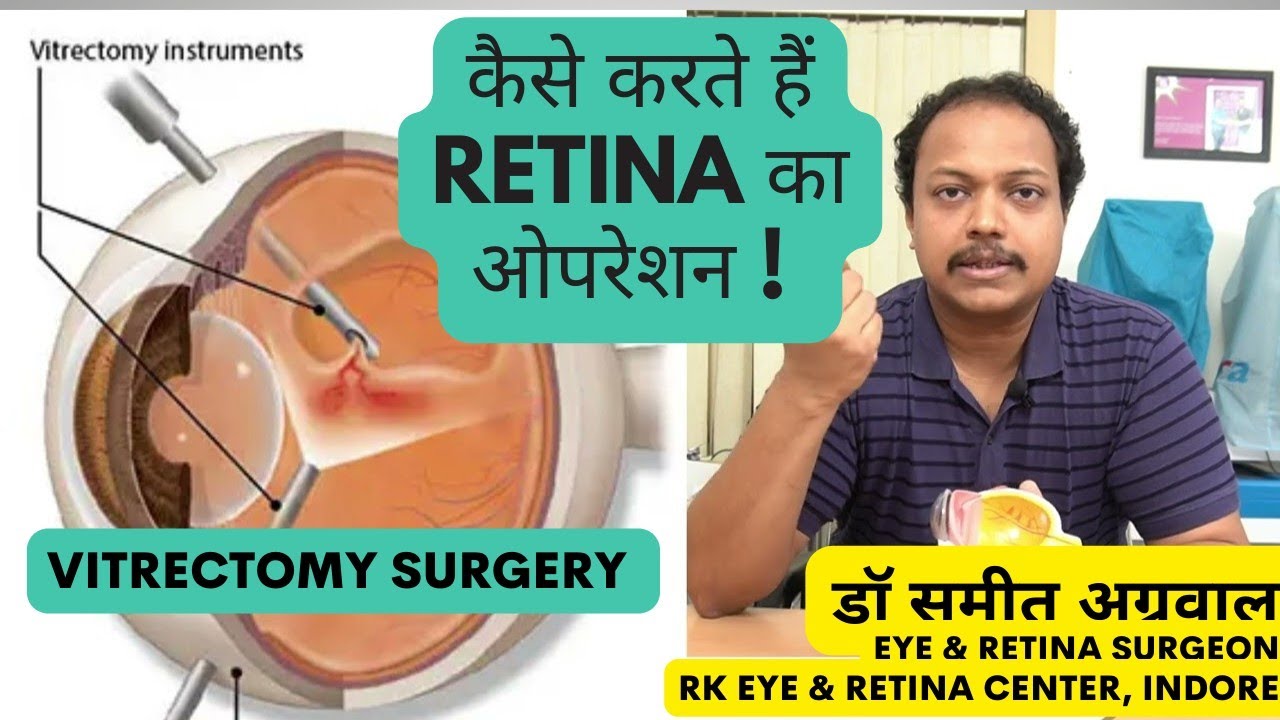 How is RETINA surgery (MIVS) done ? कैसे करते हैं रेटिना का ऑपरेशन ?