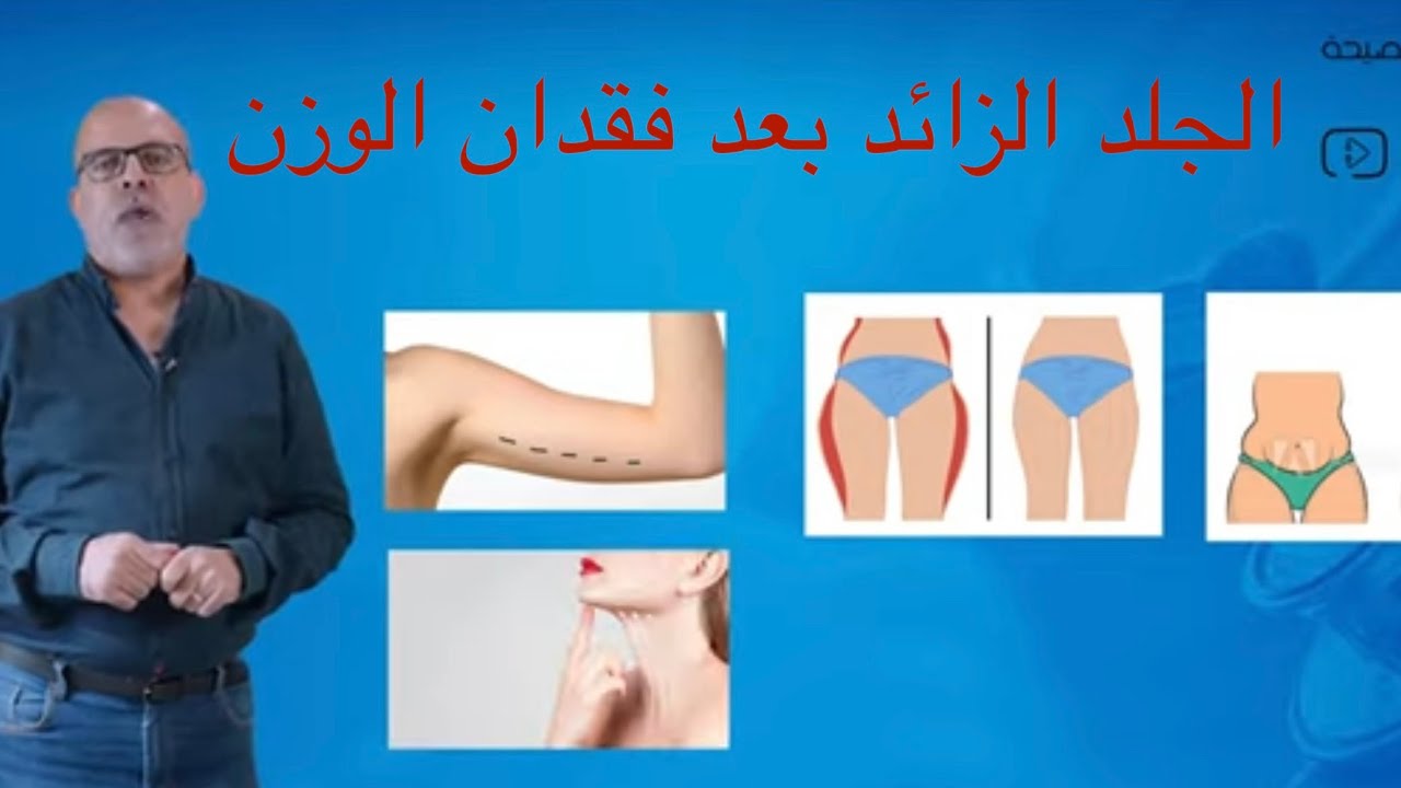 شد الجلد و الترهلات  التي تحدث بعد  جراحات السمنة او فقدان الوزن و الدايت  .  د. عبد الناصر النجار