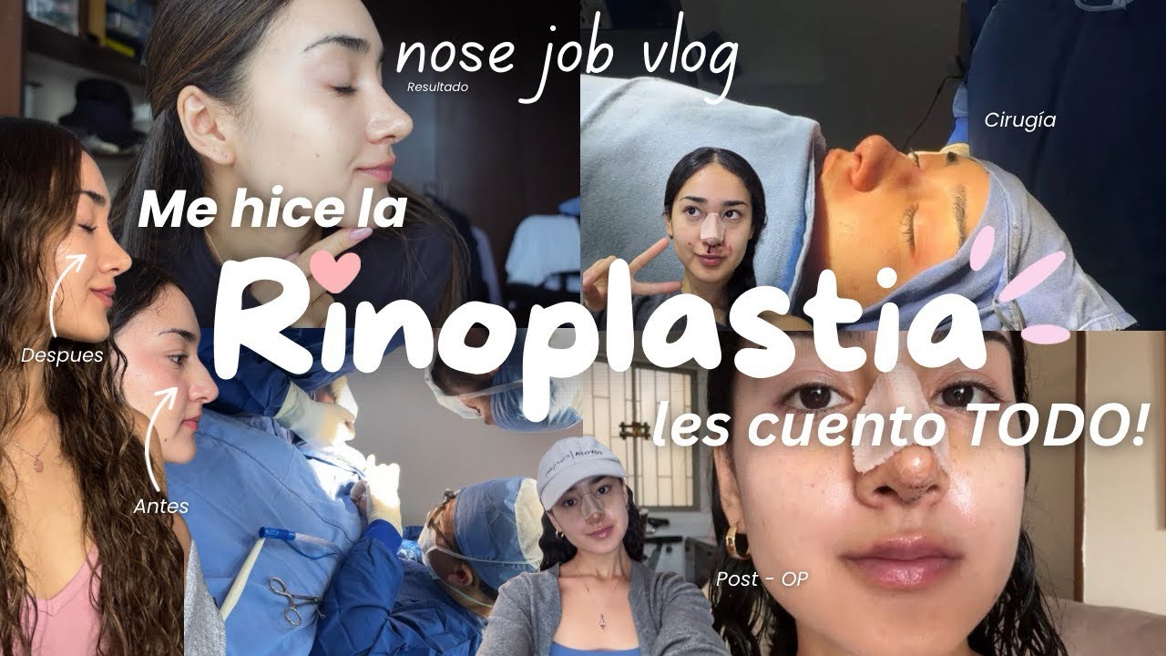 Me operé la nariz! 👃🏼 ✨🩺 Rinoplastia VLOG | aquí te cuento todo mi proceso… 🤍