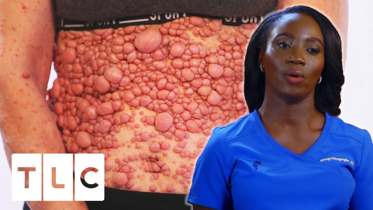 Doctor Treats One Of The Most Extensive Cases Of Neurofibromatosis She&rsquo;s Ever Seen | Dr. Mercy