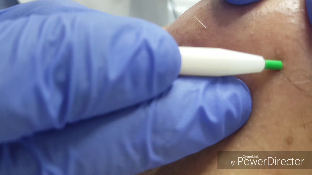 Épilation #Électrolyse : #Épilation #Définitive à 100%--  100%إزالة الشعر الكهربائية النهائية