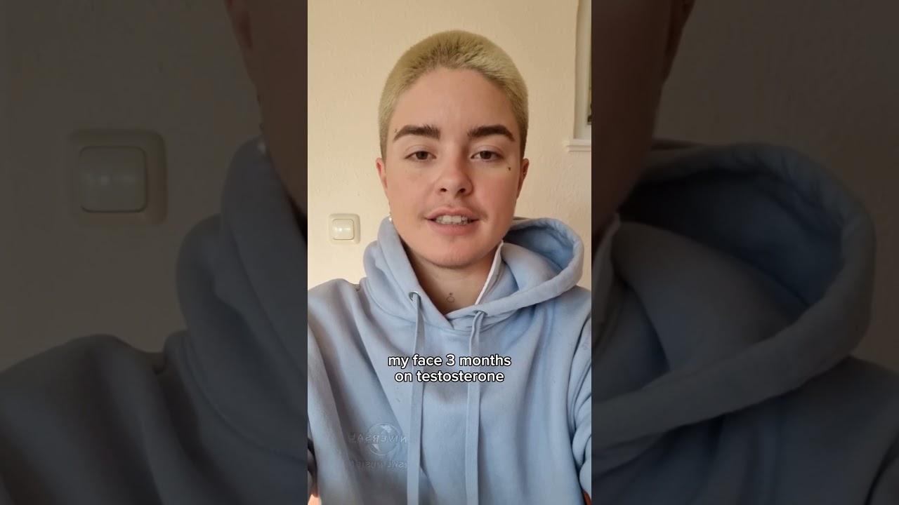 Facial changes on Testosterone #transmasc #nonbinary #nichtbin&auml;r #Testosterone