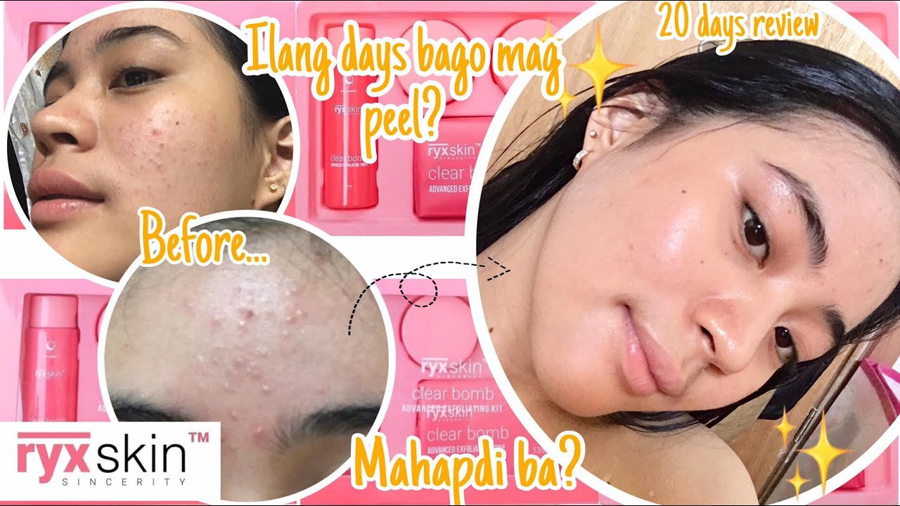 Ryx Clearbomb Honest Review (everyday update 20days) | Mikaela Regala