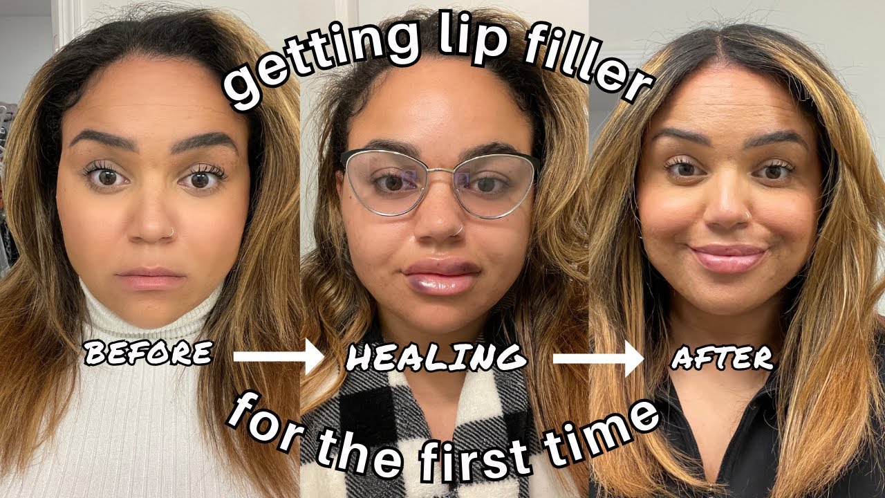 LIP FILLER VLOG *my FIRST time* // The appointment, FULL healing process + my overall experience