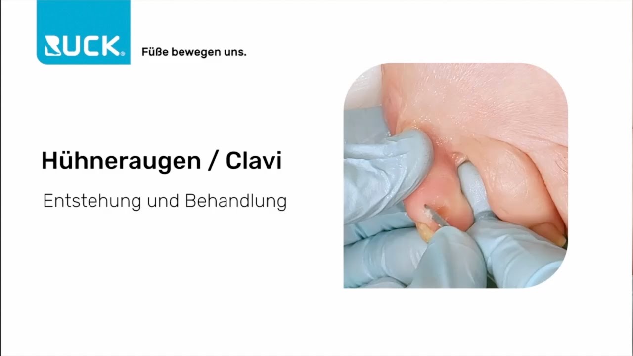 H&uuml;hneraugen? Wie man sie erkennt und behandelt