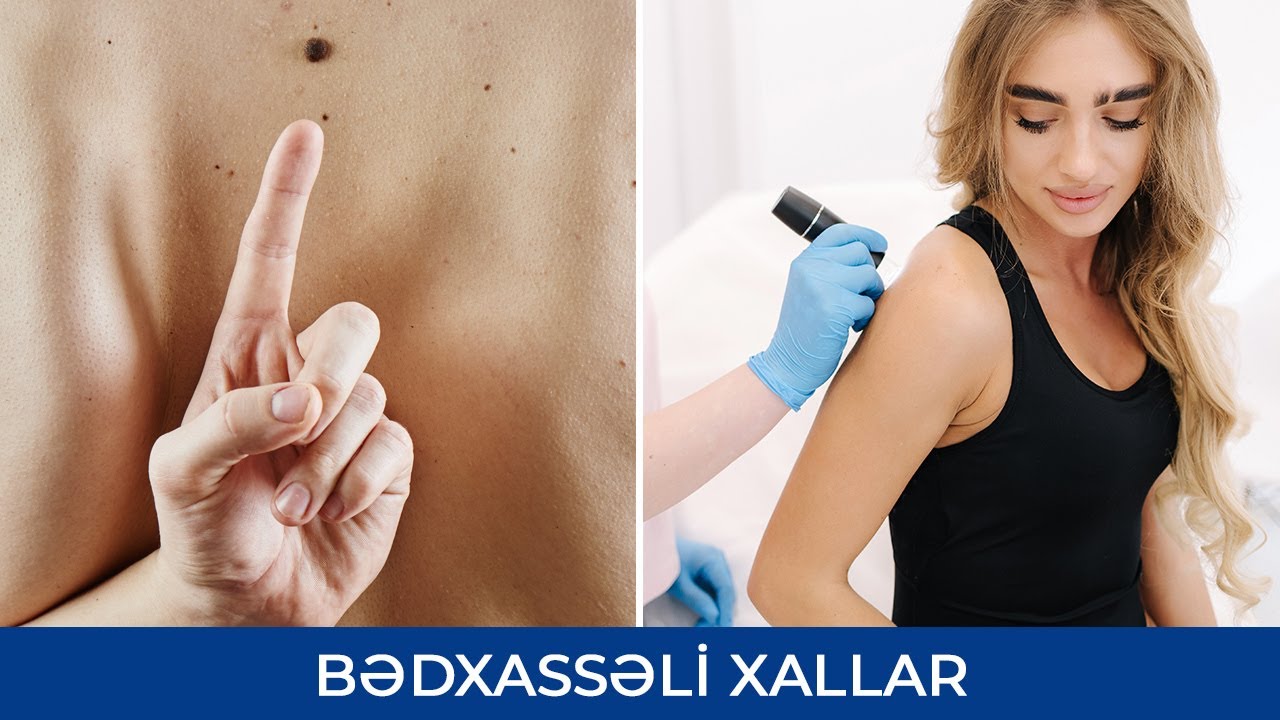 Bədxassəli Xallar - Ət xalı - Ramil Qocayev (Dermatoveneroloq-kosmetoloq)