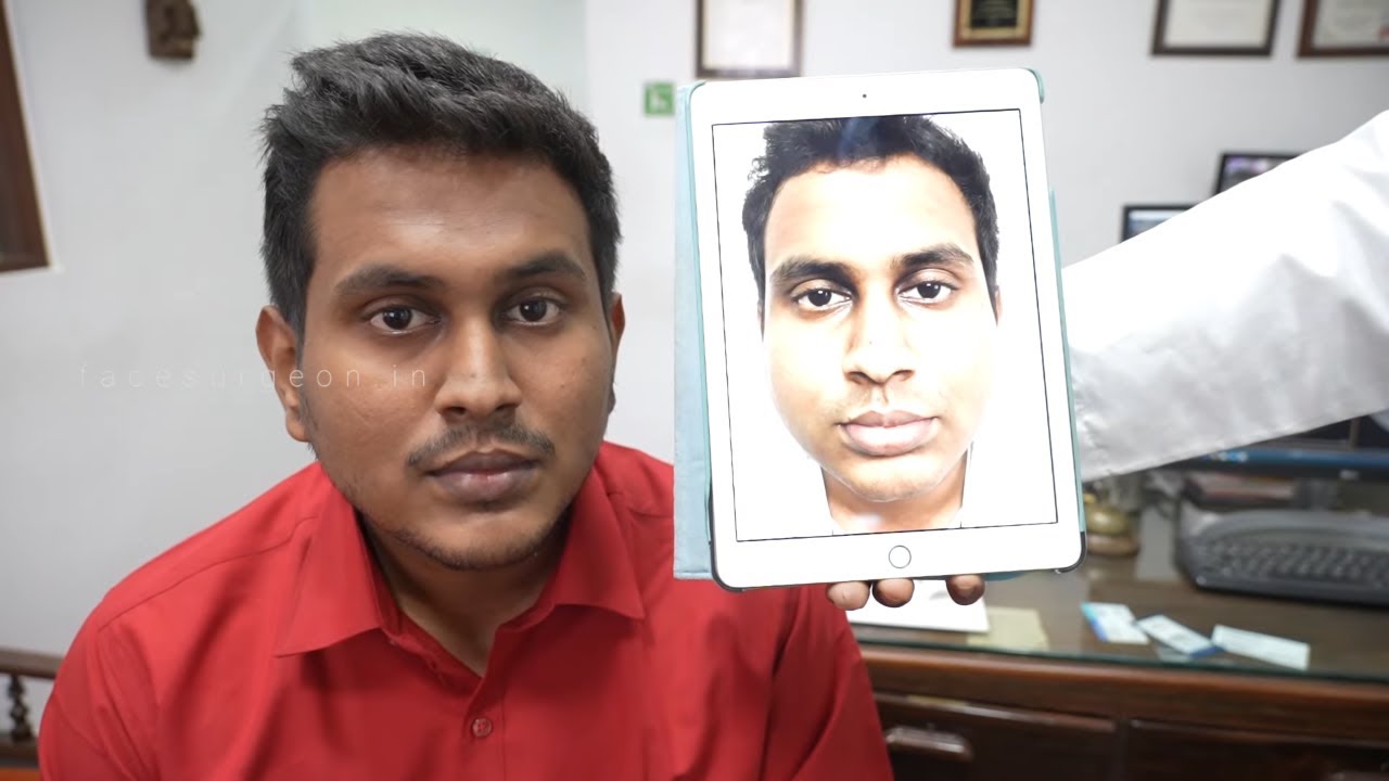 Before and After Chin Surgery (Genioplasty) - 49 Days Result - Best Transformation
