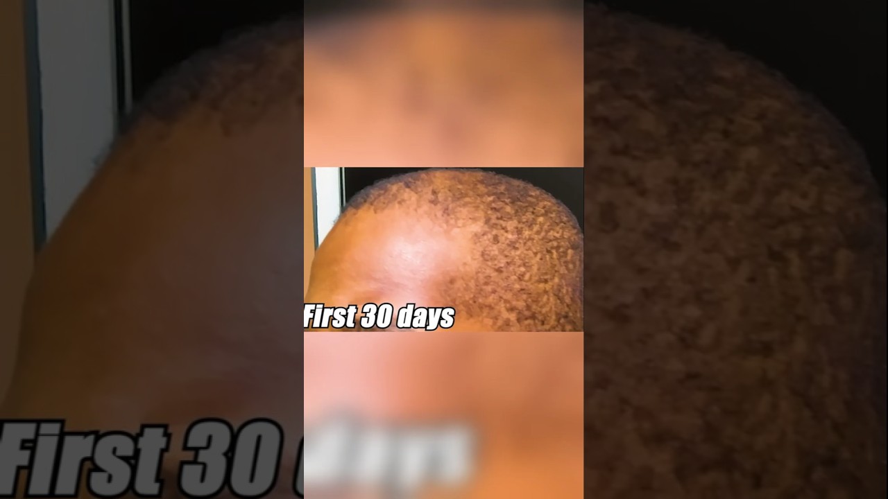 I Regrew My Hairline