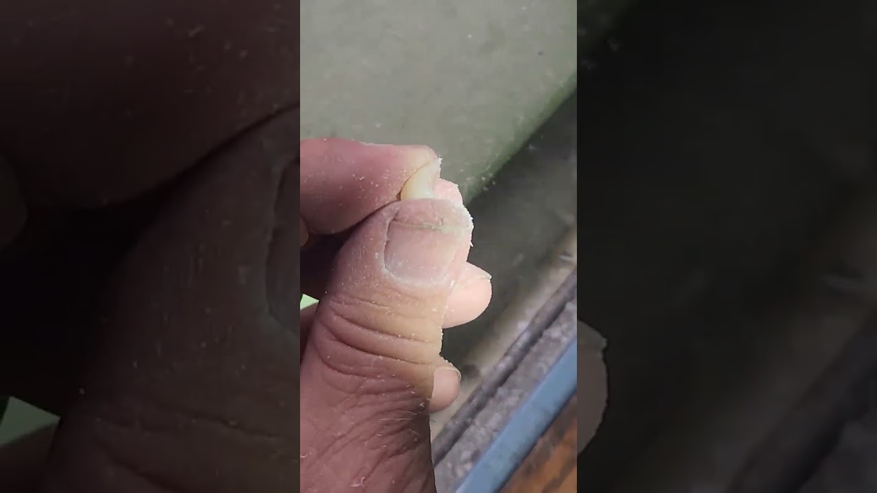 Setting anterior teeth for an overdenture