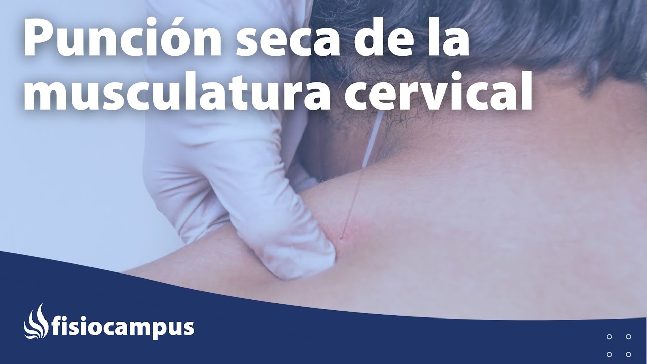 Punción seca de la musculatura cervical