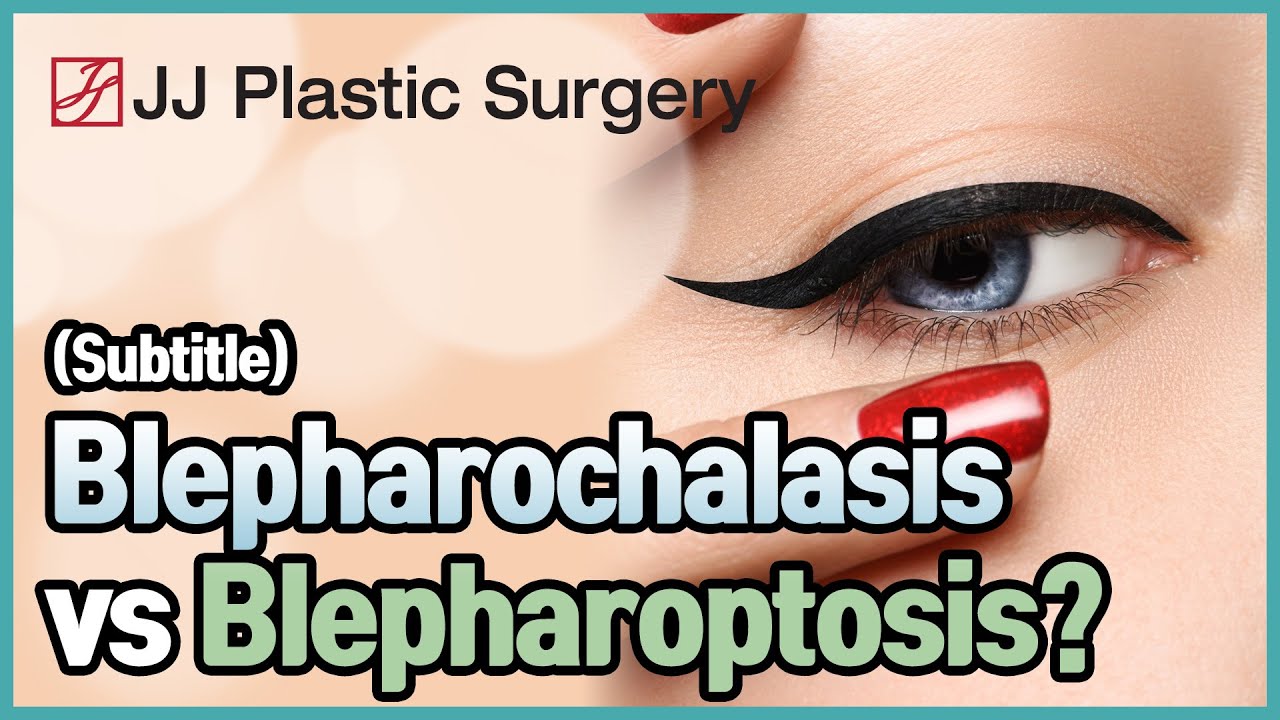Blepharochalasis vs Blepharoptosis?