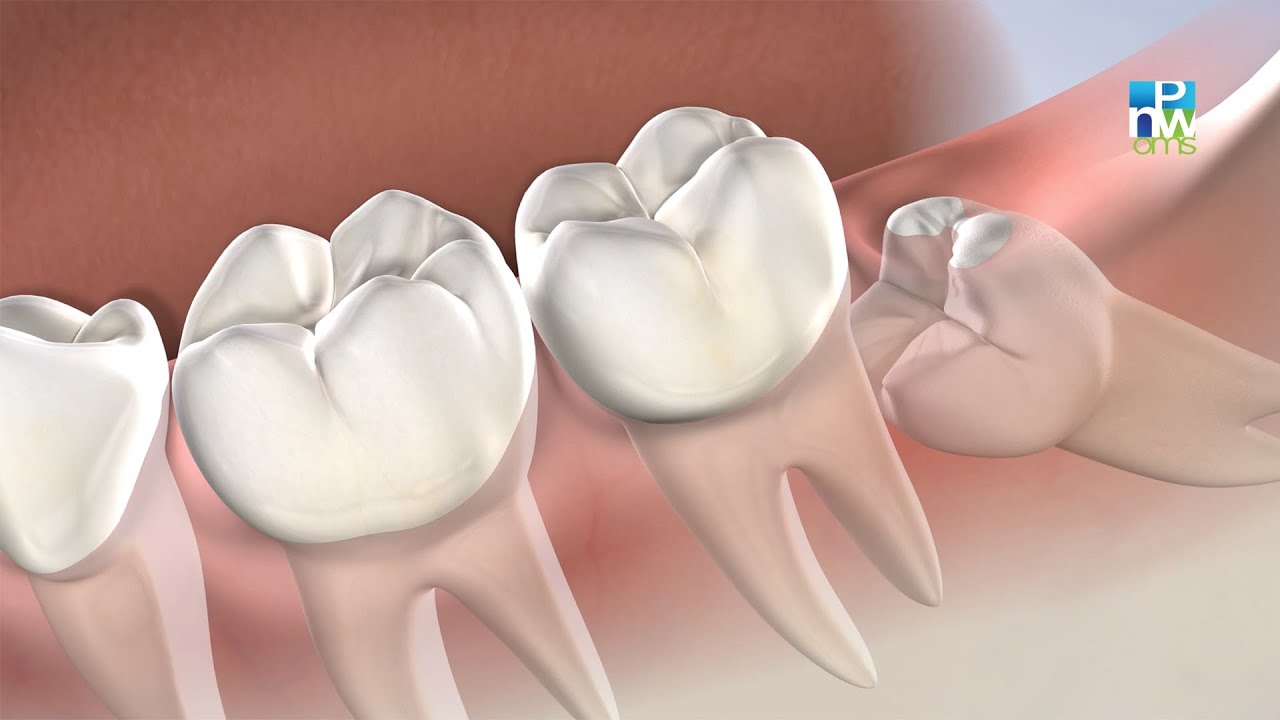 Post-Operatorio: Retiro de las Muelas del Juicio | Pacific Northwest Oral & Maxillofacial Surgeons