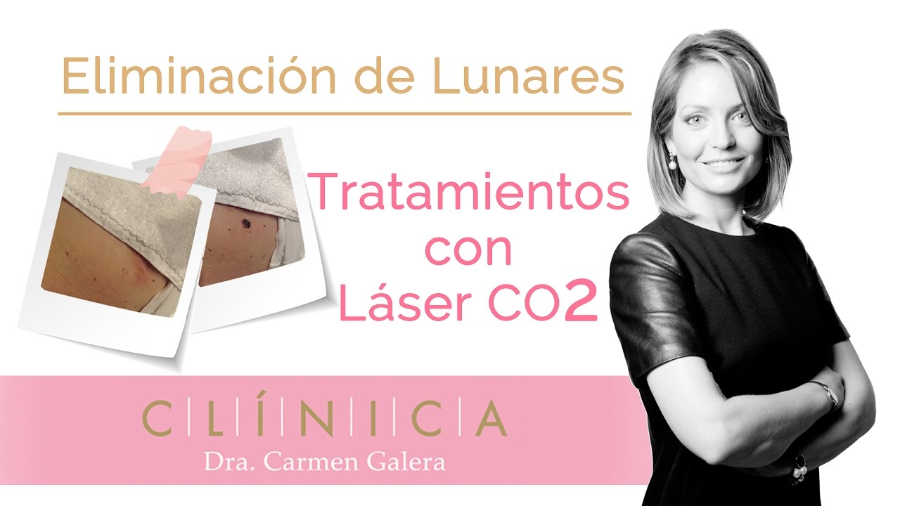Eliminacion de lunares con laser CO2