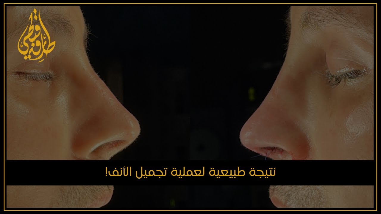مركز الدكتور طارق قبطي |  أفضل نتائج لعملية اعادة ترميم الأنف قبل وبعد لرجل