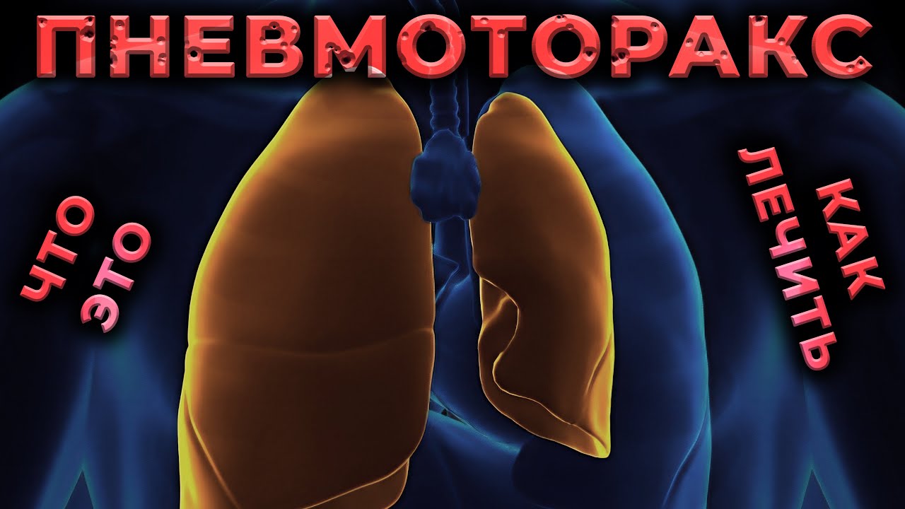Пневмоторакс просто. Что это такое и как лечить? #ПроСМП