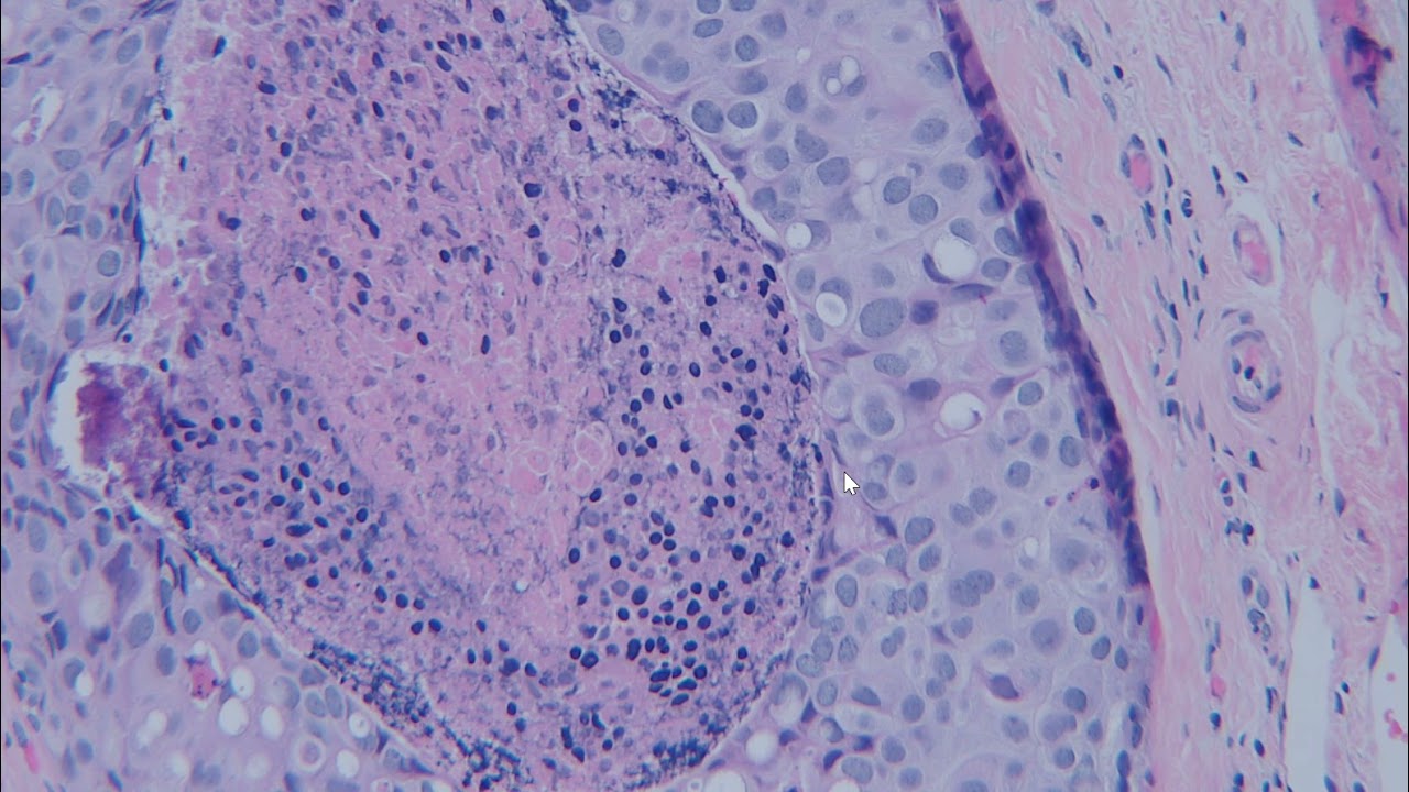 Breast Pathology Cases 3 and 4