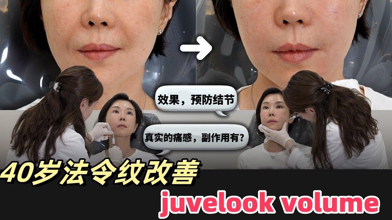 juvelook volume疼痛感究竟是是...🌸 👐I效果，疼痛I（feat.特秀恩碧明洞店）