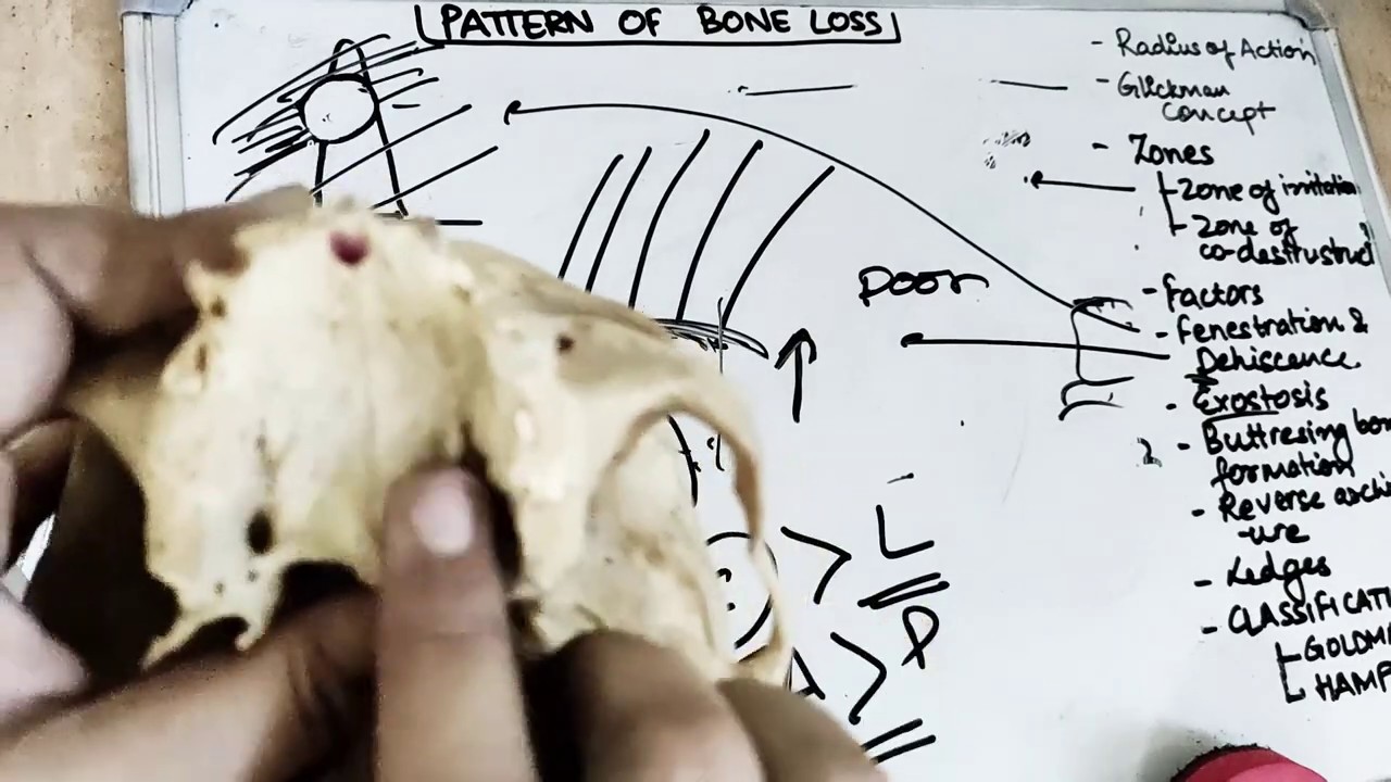 pattern of bone loss in periodontal disease