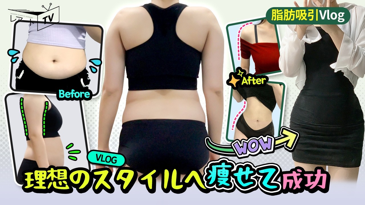 【腹部の脂肪吸引】二の腕と一緒に上半身のダイエット効果UP！UP！【レアート整形外科】