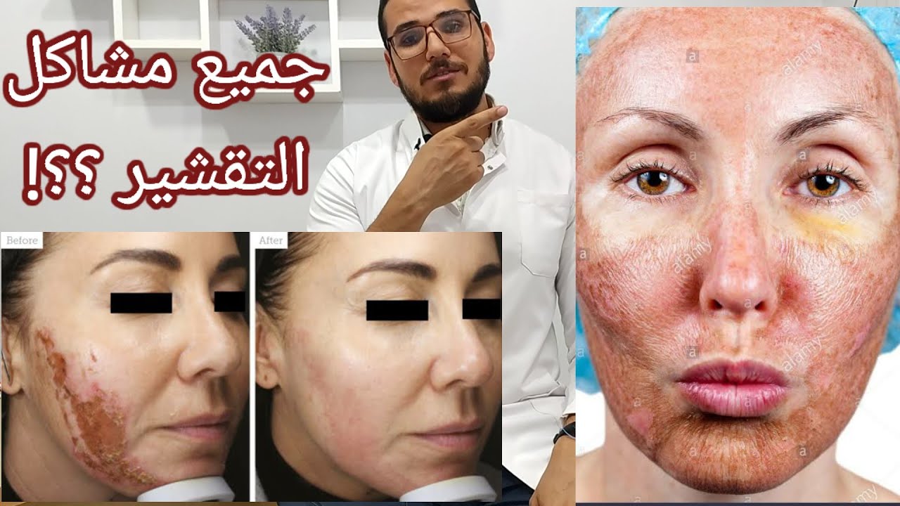 اضرار التقشير الكيميائي وازاي نتفاداها