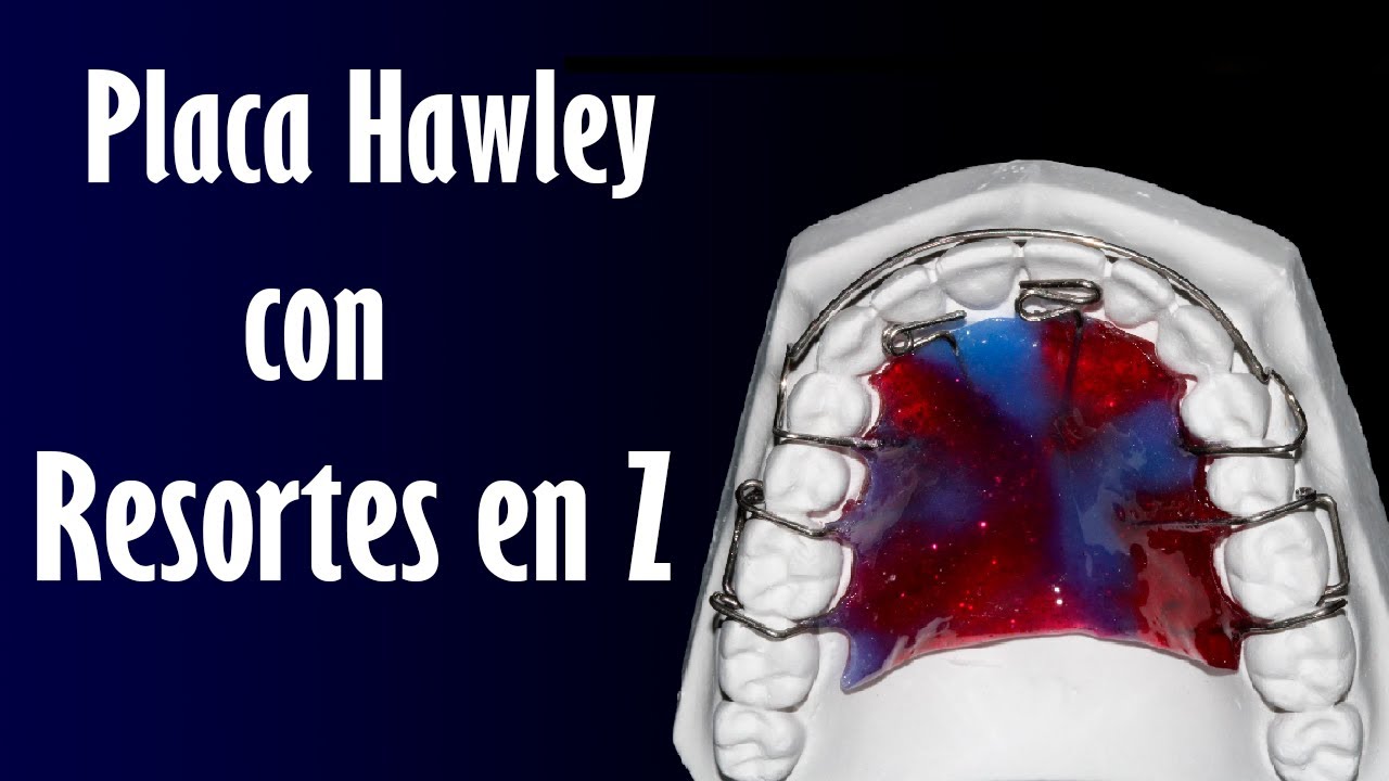 Placa Hawley con Resortes en Z | Elena Dental Art & More