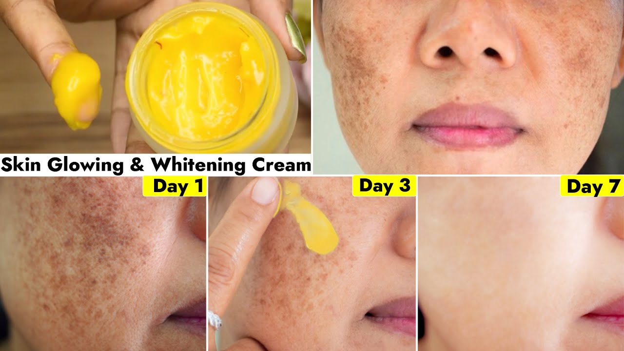 This👆🏼Face Cream Cleared Pigmentation in 3 Uses-Remove Dark Spots & Uneven Skin- Get Even Fair Skin