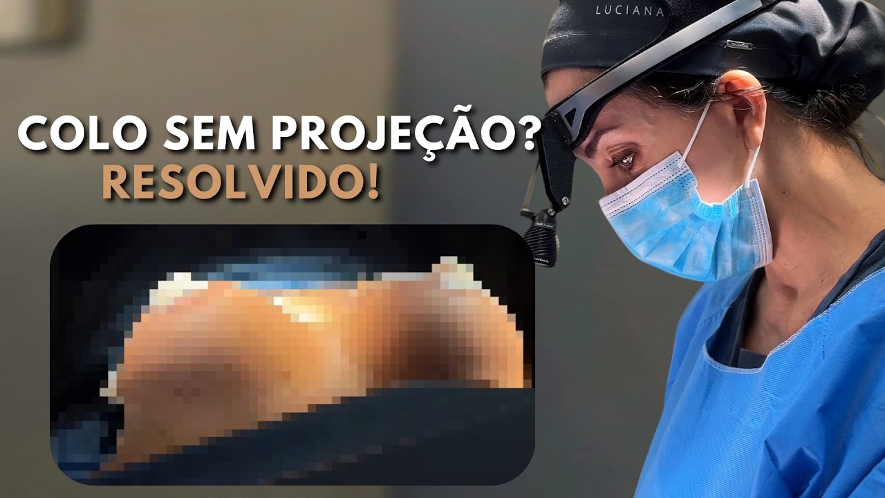 Quando o Colo Não Projeta: Troca de Prótese, Abdominoplastia Reversa e Correção de Cicatrizes