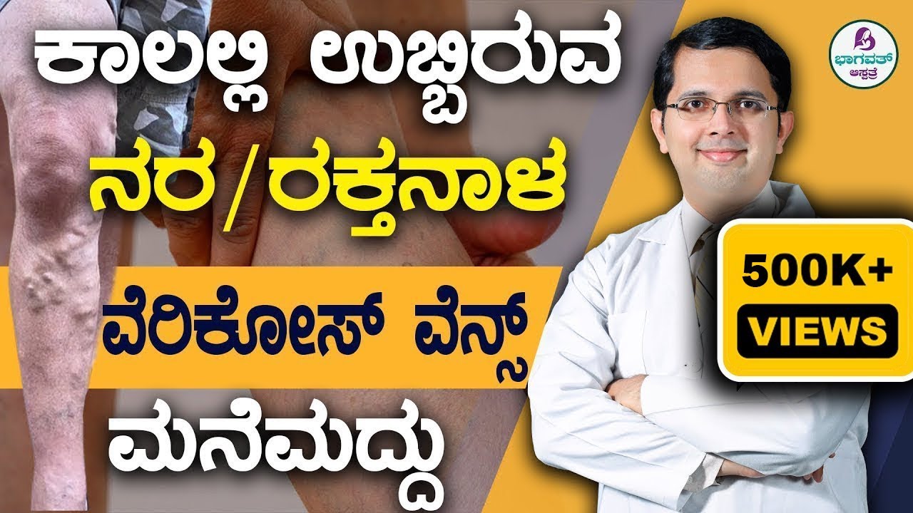 Video 54 - Varicose Veins | ವೆರಿಕೋಸ್ ವೇನ್ಸ್- ಕಾಲಲ್ಲಿ ಉಬ್ಬಿರುವ ನರ/ರಕ್ತನಾಳಕ್ಕೆ ಮನೆಮದ್ದು |Home Remedies