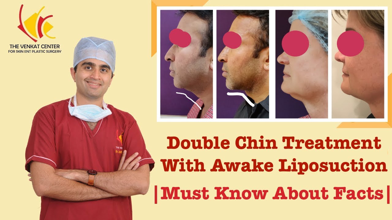 Double chin treatment with awake liposuction | Must Know about Facts| Before & After Images Included