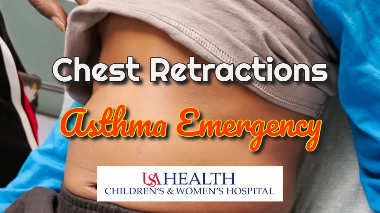 Chest Retractions in a Severe Asthma Attack
