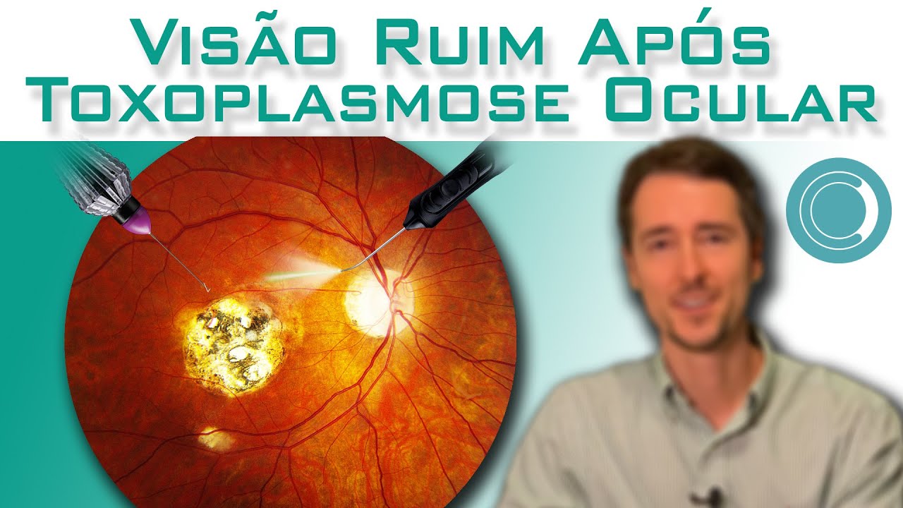Toxoplasmose Ocular -  vis&atilde;o emba&ccedil;ada ap&oacute;s o tratamento