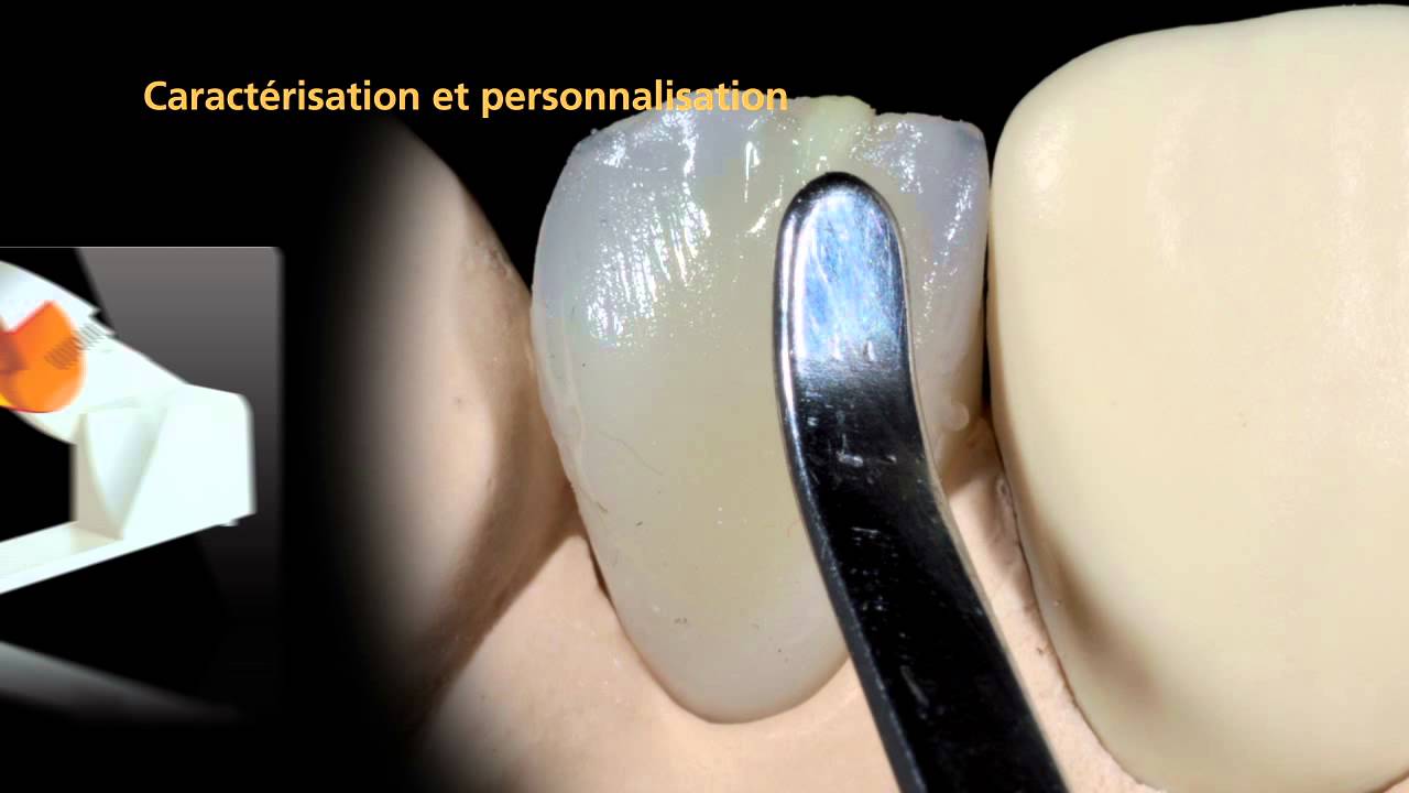 SR Nexco Paste Tutorial - Chapitre 4 - Modification des dents artificielles