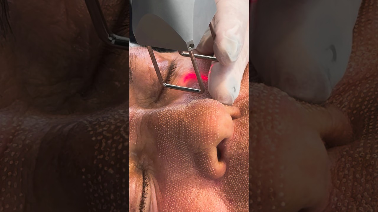 Laser CO2 fracionado atua profundamente para revelar uma nova pele: firme, lisa e iluminada. 💚