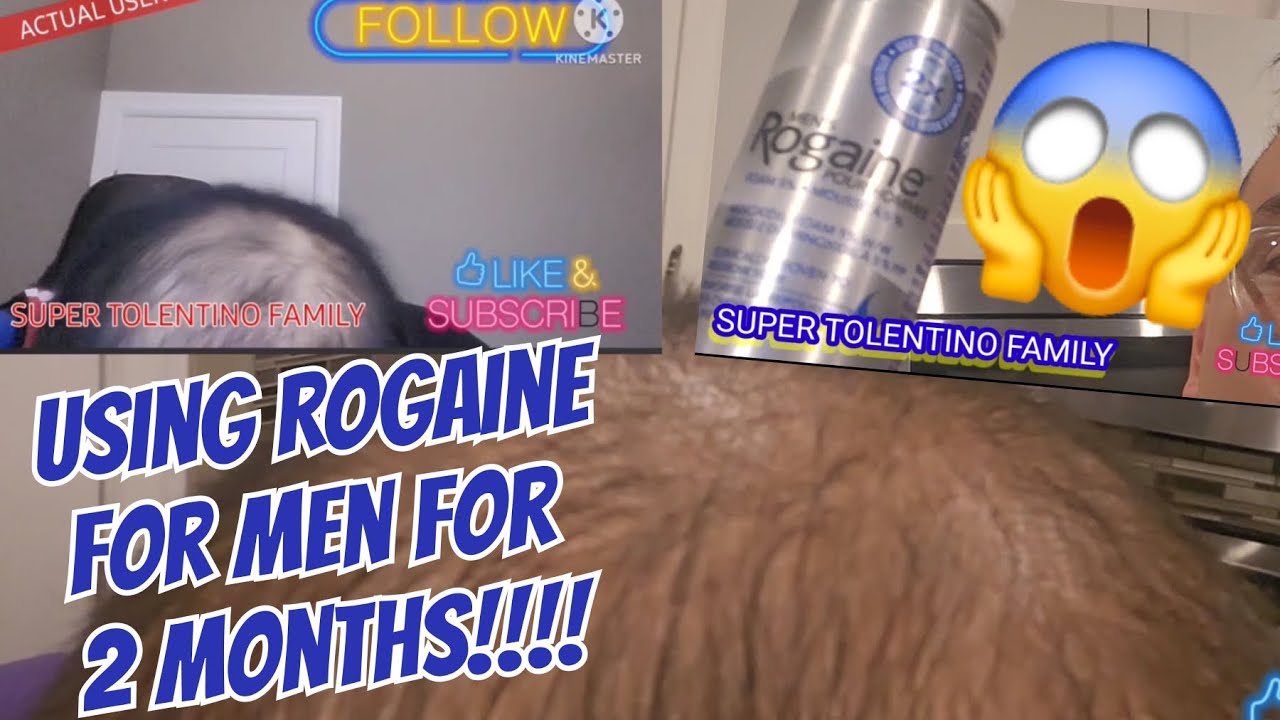 Amazing!!! Rogaine for Men Honest Review and Result After 2 Months!!!