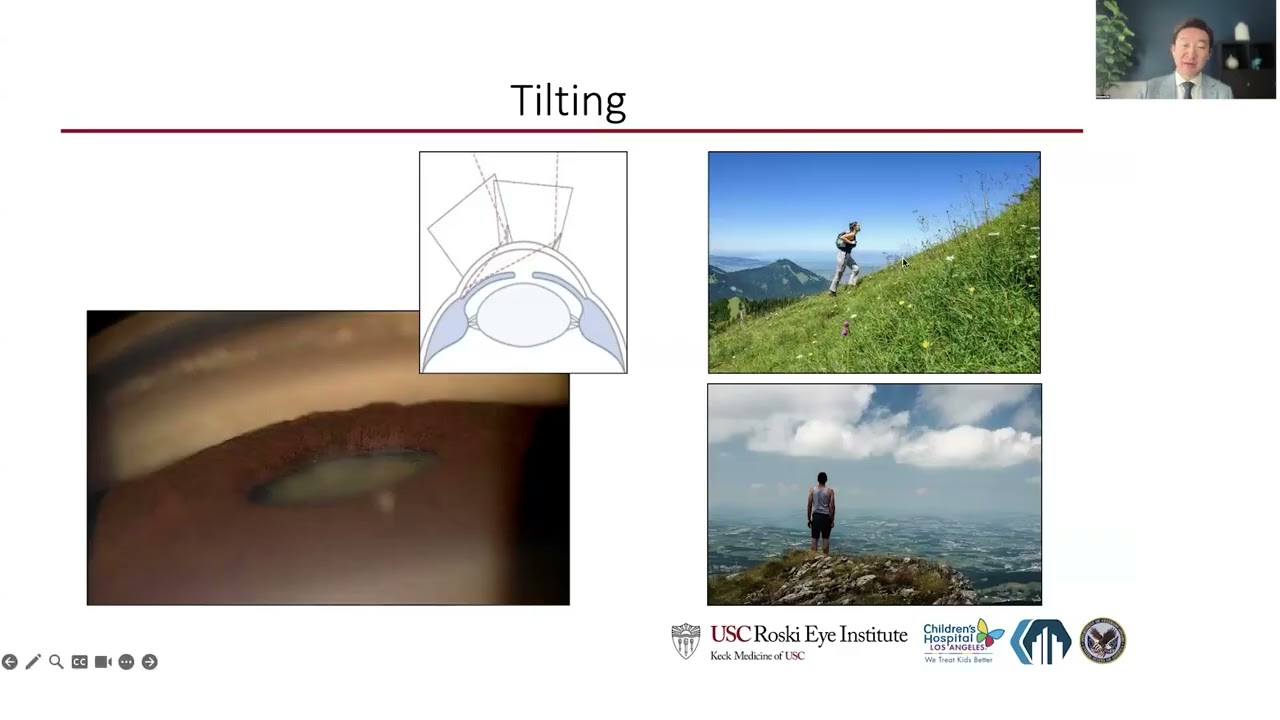 Lecture: Gonioscopy and Angle Evaluation: Fundamentals to Advanced Techniques & Technologies