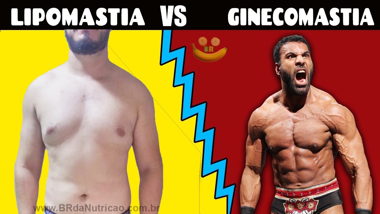 Qual a diferença entre GINECOMASTIA e LIPOMASTIA? Entenda agora!