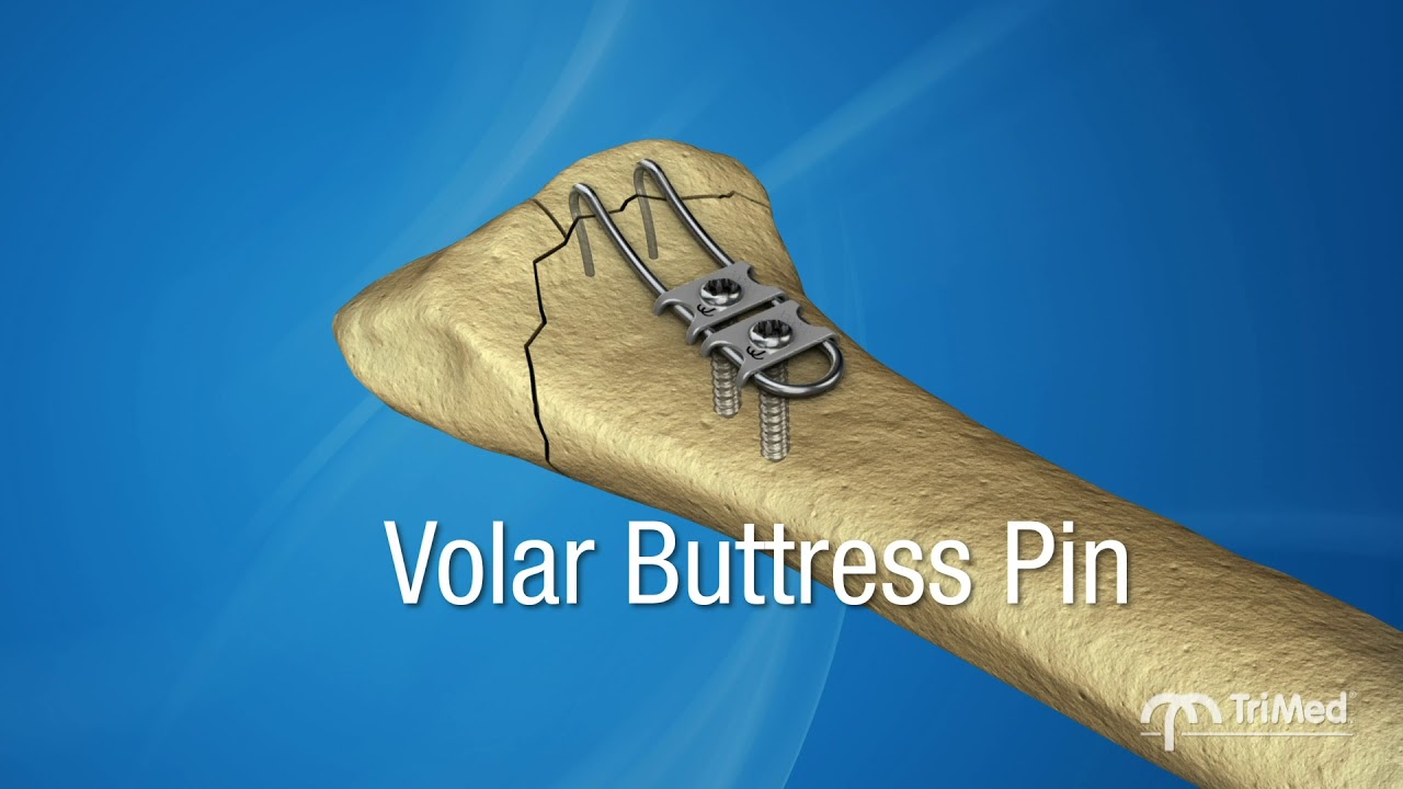 TriMed: Pioneers in Periarticular Fixation