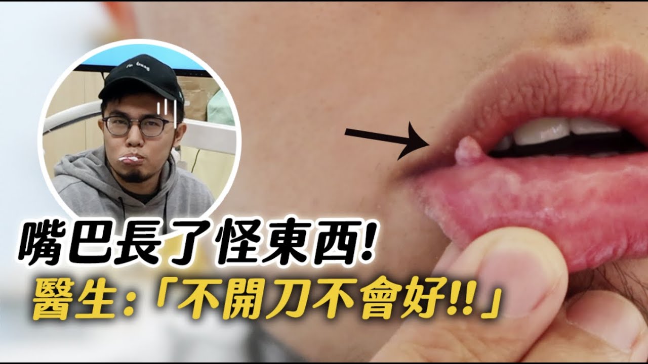 嘴巴長了怪東西⋯醫生：「不開刀不會好」【狸貓】