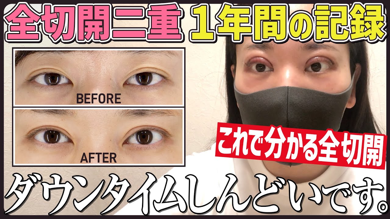 【二重整形】埋没二重から全切開二重に！１年間密着し完成した現在の目元を公開！