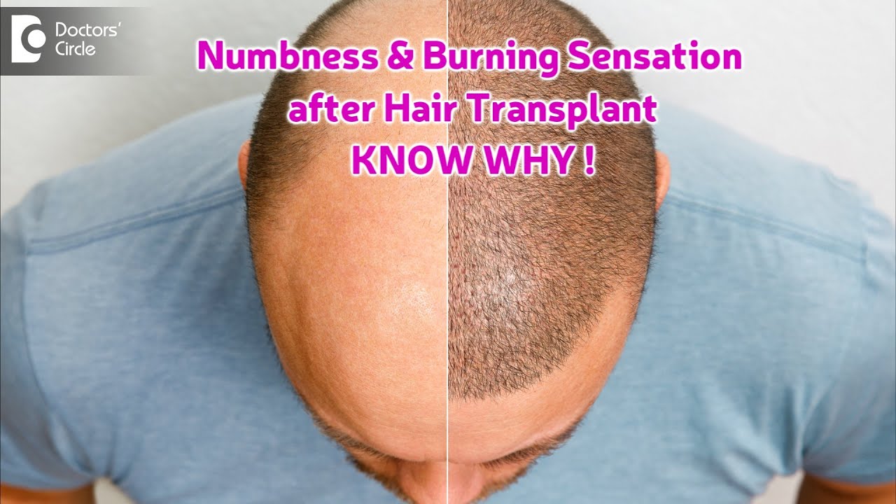Burning Sensation & Numbness after Hair Transplant - KNOW WHY! -Dr.Deepak P Devakar| Doctors' Circle