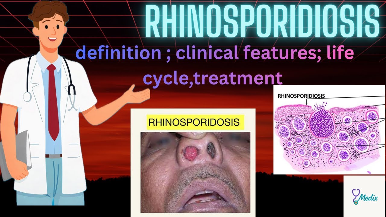 Rhinosporidiosis Lecture(Definition, clinical Features, life cycle, treatment)/ ENT lecture in Hindi