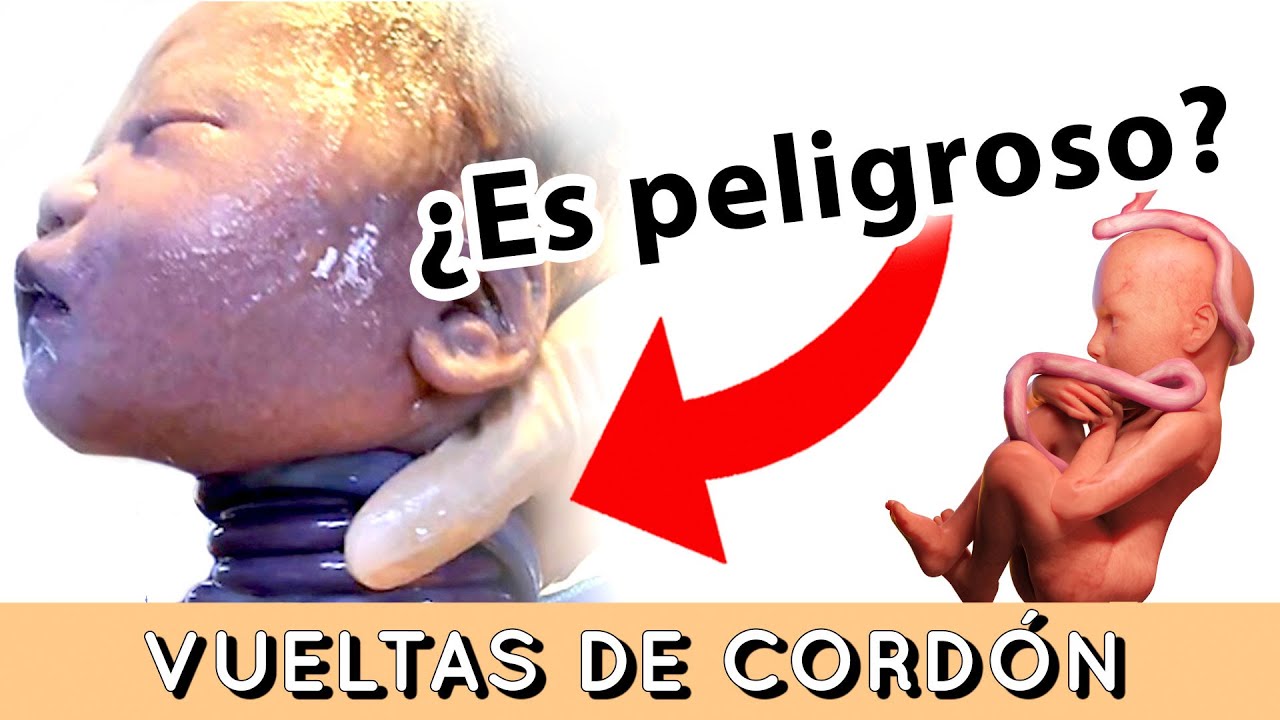 Mi bebé tiene vueltas de cordón 👶  ¿Qué hago? ¿Es peligroso tener circulares de cordón?