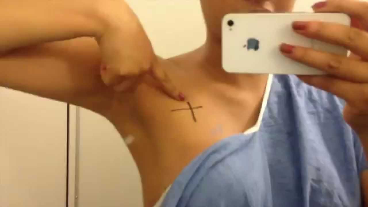 Breast Cancer Radiation Round 1 to 5