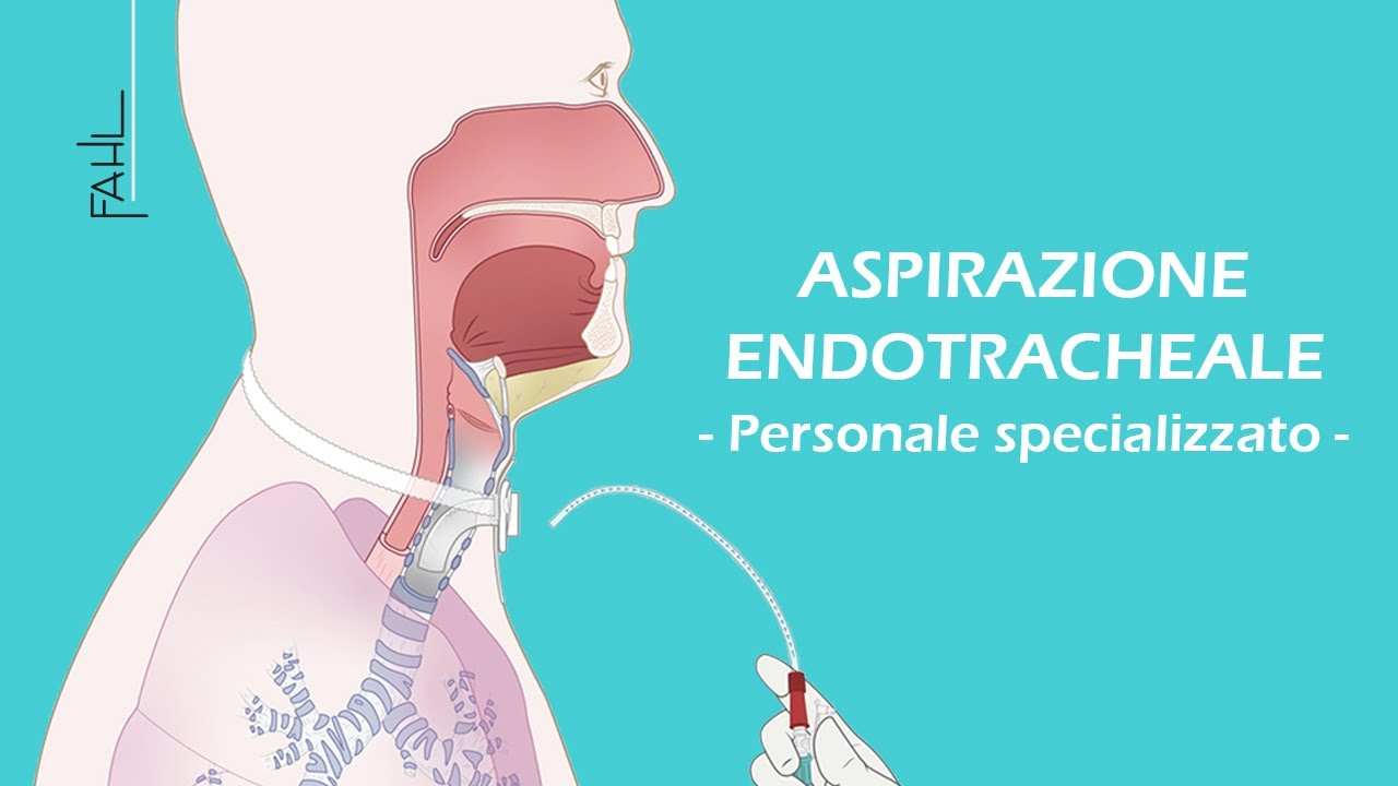 Aspirazione endotracheale per personale infermieristico | Fahl Medizintechnik-Vertrieb GmbH