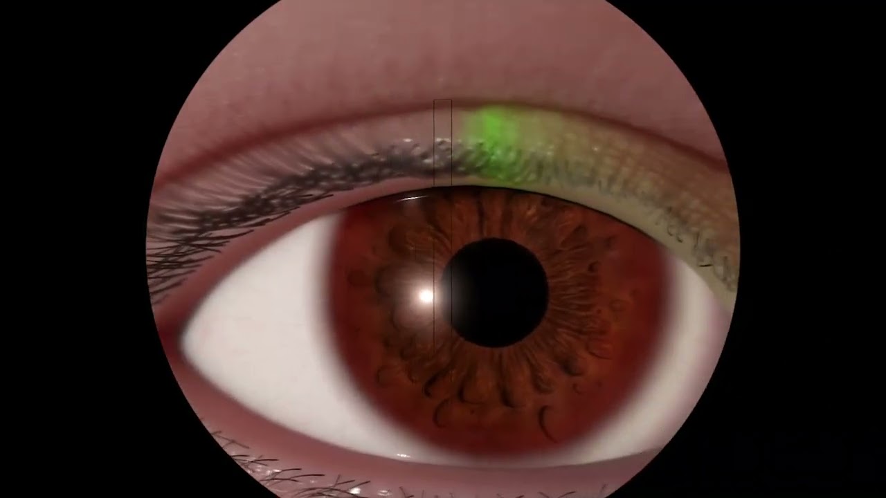 Courseware overview Eyesi Slit Lamp Simulator 2022