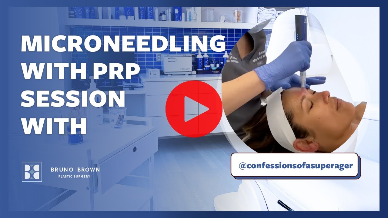 Microneedling with PRP Session with @confessionsofasuperager -- See her Results!!