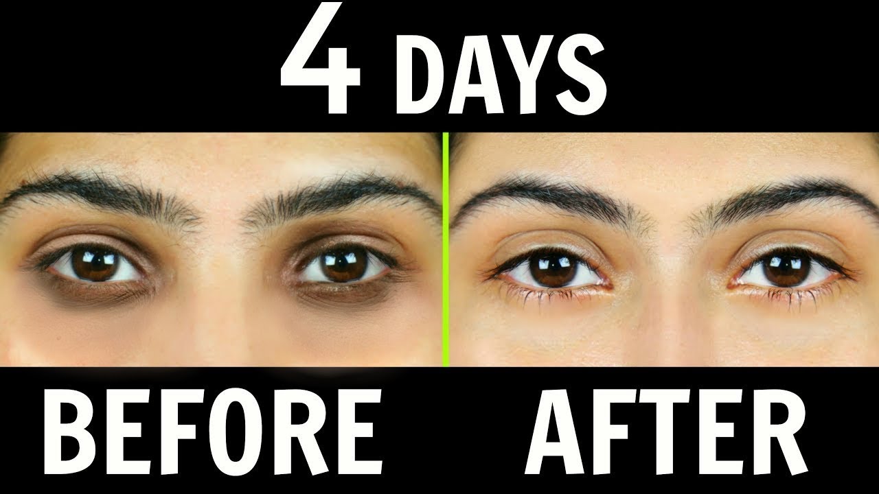 How to Remove Dark Circles Naturally in 4 Days (100% Results) | Anaysa