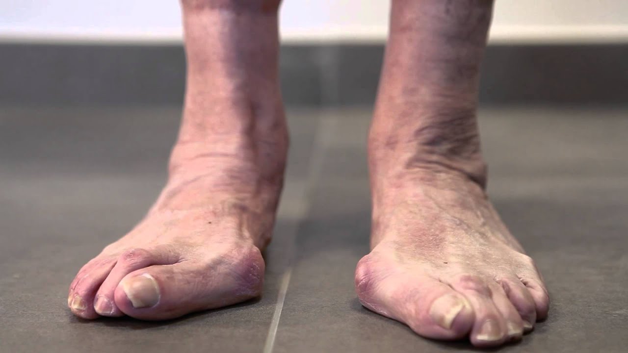 Hallux Valgus