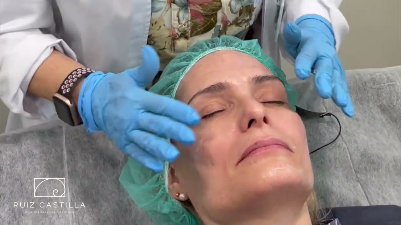 Tratamiento IPL para manchas y arañas vasculares.
